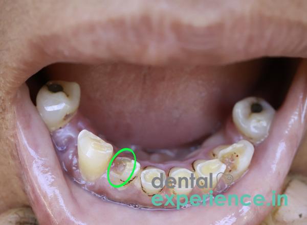 Fractured tooth